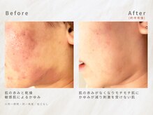 メレ(mele)/20代敏感肌／毛穴