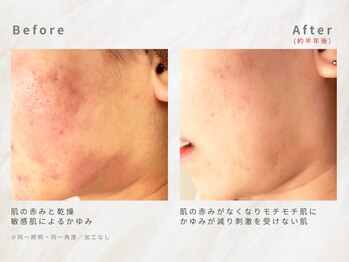 メレ(mele)/20代敏感肌/毛穴