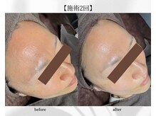 アン ビューティー(ann beauty)/施術2回【症例写真】