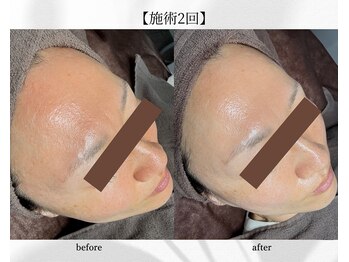 アン ビューティー(ann beauty)/施術2回【症例写真】