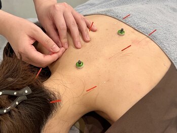 リトリートハリ 大阪梅田院(Re:treat HARi)の写真/【120分集中ケア】冷え・むくみ・慢性疲労を全身から整える本格美容鍼灸
