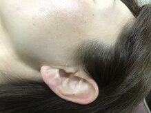 ナノハナ/鹿沼市の全身脱毛のナノハナ