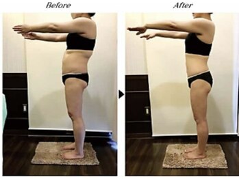 ビューティークリニックコダマ 宮崎本店/【2か月コース】M.N 様 （38歳）