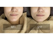 エクラルム(Eclaleum)/BeforeAfter　PHA水光ピーリング