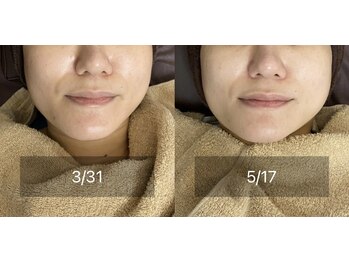 エクラルム(Eclaleum)/BeforeAfter　PHA水光ピーリング