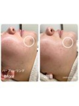 ラウレア 西条店(LAULEA)/ハーブピーリングBefore/After 