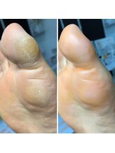 長岡巻き爪矯正センター/30代男性ビフォーアフター