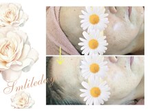 スマイルデイズ(Smiledays)/40代前半　3回目の施術