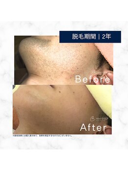 メンズクリア 倉敷店/【メンズクリア】お客様の施術例