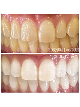 ホワイトニングルーム 横浜店(Whitening Room)/ホワイトニング/横浜