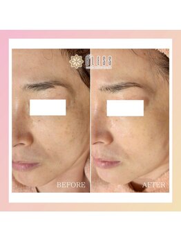 エステサロン ブレス 長町南店(BLESS)/シミ結果