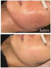 プレジール(Plaisir)/人気No. 1サーマ＋ララピ-ル+LDM