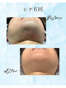 レシズモ(LESSISMO)/メンズヒゲ6回ビフォーアフター