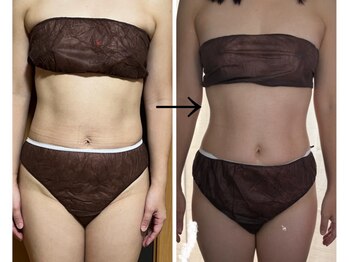 スーコ(SU:CO)/脂肪分解プライムセラム　お腹