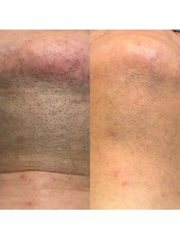 メンズプシュケ(men's PSYCHE)/ひげ脱毛6回目