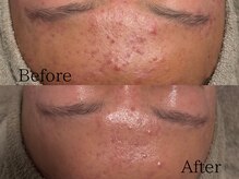 ルミライズ(lumirise)/〈2回目での効果〉