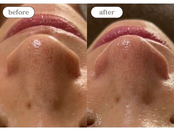 リスタ(RSTA)/【BEFORE/AFTER】