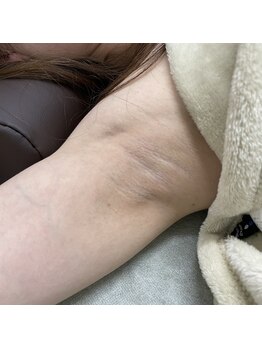 ナノハナ/鹿沼市の全身脱毛のナノハナ