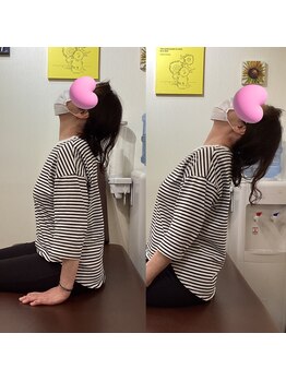 ヒデ整体院(Hide整体院)/猫背矯正骨盤矯正B/A肩こり腰痛