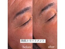 シュカ(Shuka)/ハーブピーリング