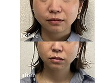愛 まぁる/40代施術部位：アゴ下　1回 2cc