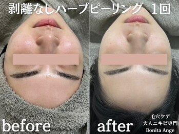 ボニータアンジュ 恵比寿(Bonita Ange)/恵比寿ハーブピーリング｜症例