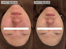 テンニック(10nick)/症例写真/ハーブピーリング