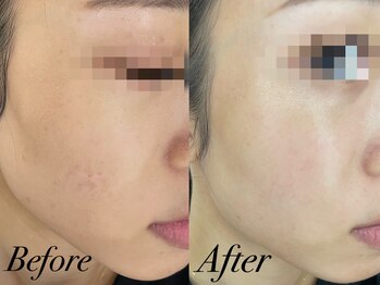 リララ 江坂店(Lelala)/ハーブ☆ビフォーアフター