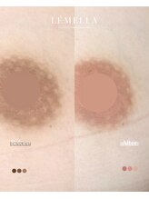 エルビービュティーサロン(LB BEAUTY SALON)/【ルメラ乳輪】実績数関西1★