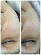 メイユール(MEILLEUR)/光フェイシャル