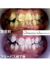 ホワイトニングサロン 京都烏丸店/ホワイトニング施術例