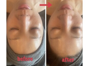 ダリア(Dahlia)/ハーブピーリング