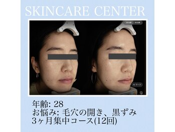 アンジェラックス スキンケアセンター心斎橋/28歳　毛穴黒ずみケア