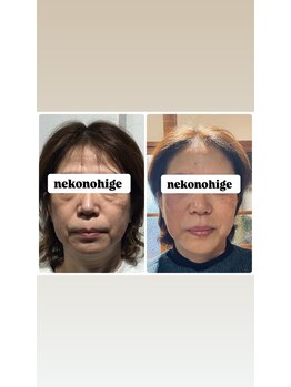 ねこのひげ/10ヶ月継続の結果