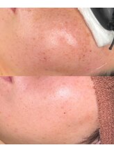 プルメリア(Plumeria)/シミケア３回目