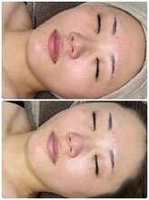 ビープラス(Biplus)/毛穴の汚れなかった事に!!