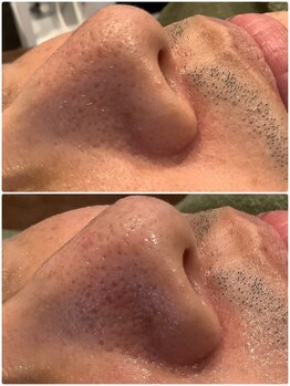 リソル(RISOL)/メンズフェイシャル人気♪