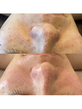 シグネット(Cygnet)/プロセルセラピーズフェイシャル