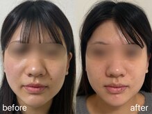 salon emma 【フェイシャルサロン&ネイルサロン】小顔/たるみ/韓国ネイル/3回目直後◎ほうれい線