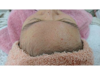 サロンエム(Salon m)/アクネ菌ケア