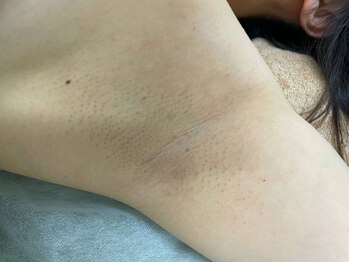 ナノハナ/鹿沼市の全身脱毛のナノハナ