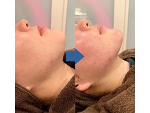 ピュアトゥルー 岐阜西店(PureTrue)/フェイスラインを綺麗に!