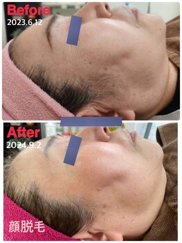 ソレイユ/顔脱毛のメリット