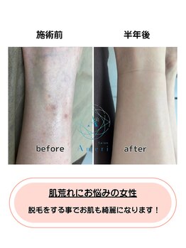 サロンアメリ 御座店(Salon Ameri)/高知　全身脱毛　サロンアメリ