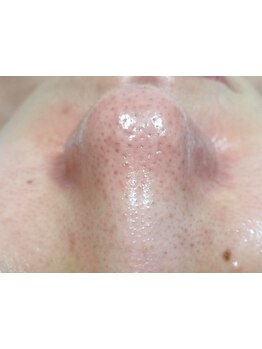 毛穴ケアをしたい