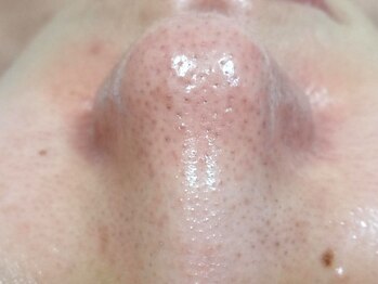 りりあすの写真/あなたの毛穴開きの原因、知ってますか?正しいケアと知識で毛穴レスな陶器肌へ