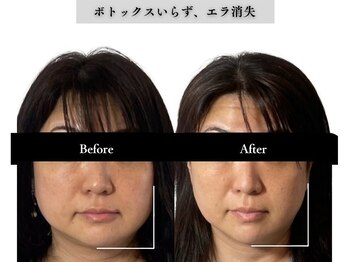 アロエベル(aloe Belle)/Before After（4回施術）