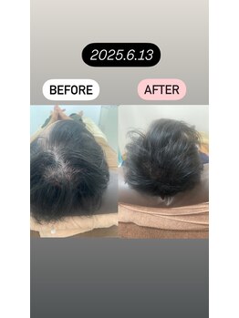 徳島美容サロン/臍帯由来幹細胞リグロー同時施術