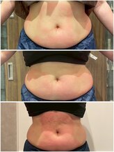 ビュウナ 銀座(BEAUNA)/脂肪冷却/frozen8