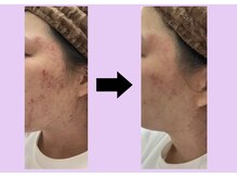 エヌフェイシャル(N.facial)/極度の肌荒れ